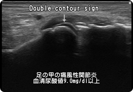 痛風・痛風性関節炎・double contour sign